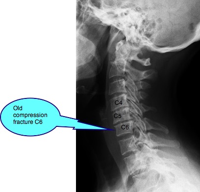 Cervical rib casefile shows the rudimentary ones are oft of little