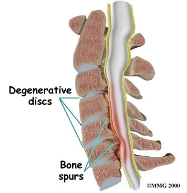 Arthritis Lumbar Spine Tingling Feet 29