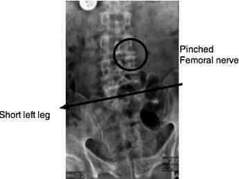 Nerve Pain: Nerve Pain Leg Front