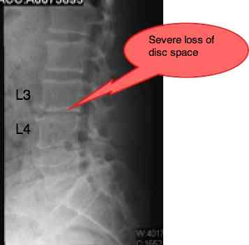 Femoral nerve casefile has severe pain in the front of the thigh.