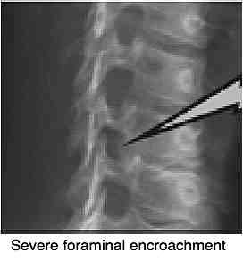 Read more newsletter CHIROPRACTIC HELP Whiplash and the Joints of Luschka …