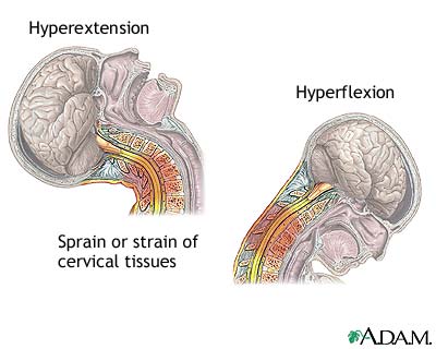 Fixation of the joints causes them 