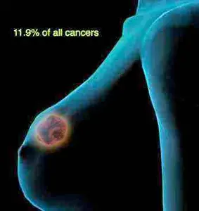 Breast cancer pandemic