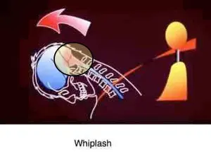 Symptoms of whiplash