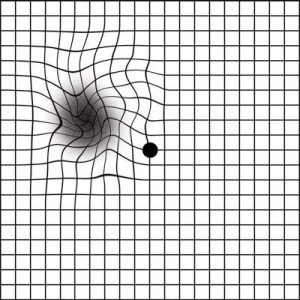 Amsler grid macular degeneration. Amsler grid macular degeneration.
