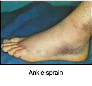 Ankle sprain ecchymosis