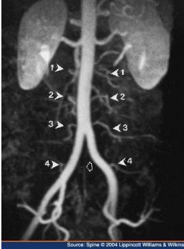 Atherosclerosis of the aorta showing lumbar arteries Atherosclerosis of the aorta showing lumbar arteries