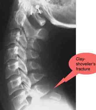 X-ray of a clay-shovellers' fracture in the cervical spine; can happen to tree planters if you are not careful. X-ray of a clay-shovellers' fracture in the cervical spine; can happen to tree planters if you are not careful.