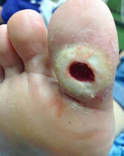 Diabetic foot ulcer