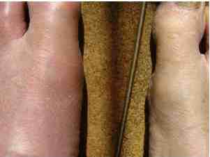 Bernard Preston's gouty toe. Bernard Preston's gouty toe.