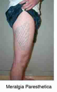 Lateral femoral cutaneous nerve distribution. Lateral femoral cutaneous nerve distribution.