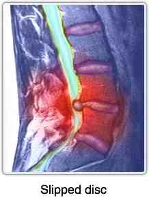 Lumbar MRI slipped disc Lumbar MRI slipped disc