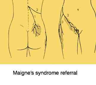 Maigne's syndrome referral. Maigne's syndrome referral.