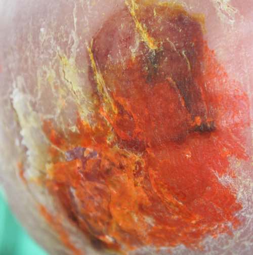 Nearly healed bedsore using turmeric and raw honey Nearly healed bedsore using turmeric and raw honey