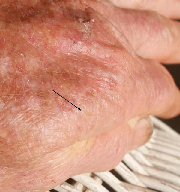 Pinching thumb and forefinger is a good frailty test