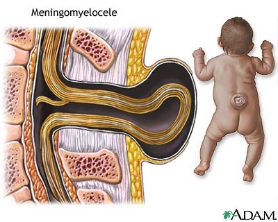 Spina bifida vera can cause a meningomyelocele Spina bifida vera can cause a meningomyelocele