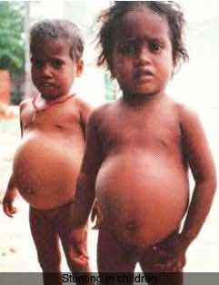 Stunting Kwashiorkor Stunting Kwashiorkor