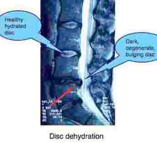 Worn disc cartilage on MRI