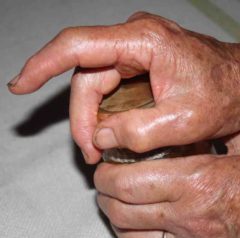 Arthritic fingers Jean