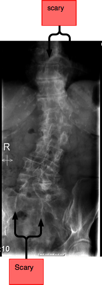 Arthritis in lower back Arthritis in lower back