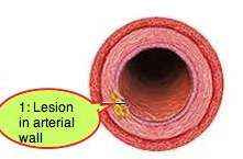 Stage 2 of atherosclerosis of the aorta. Stage 2 of atherosclerosis of the aorta.