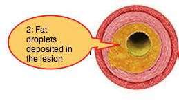 Inflammed artery clogged with fat Inflammed artery clogged with fat