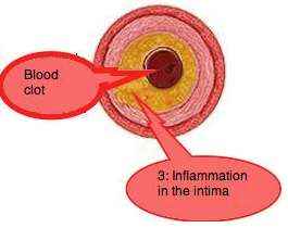 Inflammed artery Inflammed artery