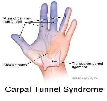 Carpal tunnel affects the median nerve causing tingling in the arms and hands. Carpal tunnel affects the median nerve causing tingling in the arms and hands.
