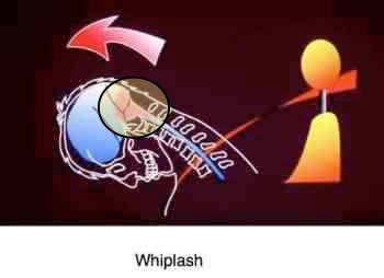 Symptoms of whiplash often include a brainstem injury. Symptoms of whiplash often include a brainstem injury.